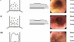 Эзофагит, вызванный вирусом простого герпеса (герпетический эзофагит, герпес-эзофагит) классификация